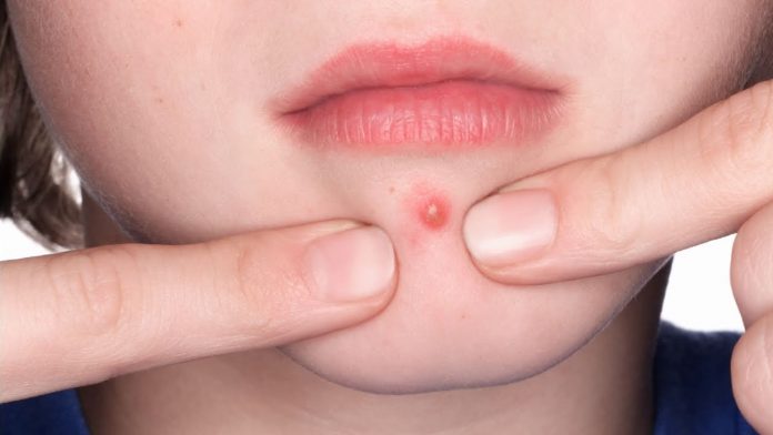 maxresdefault (2) How to pop a pimple