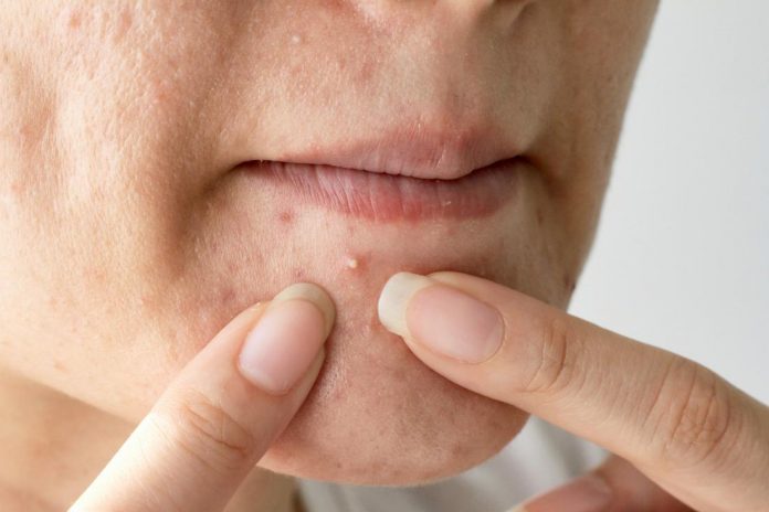 How to get rid of pimples?