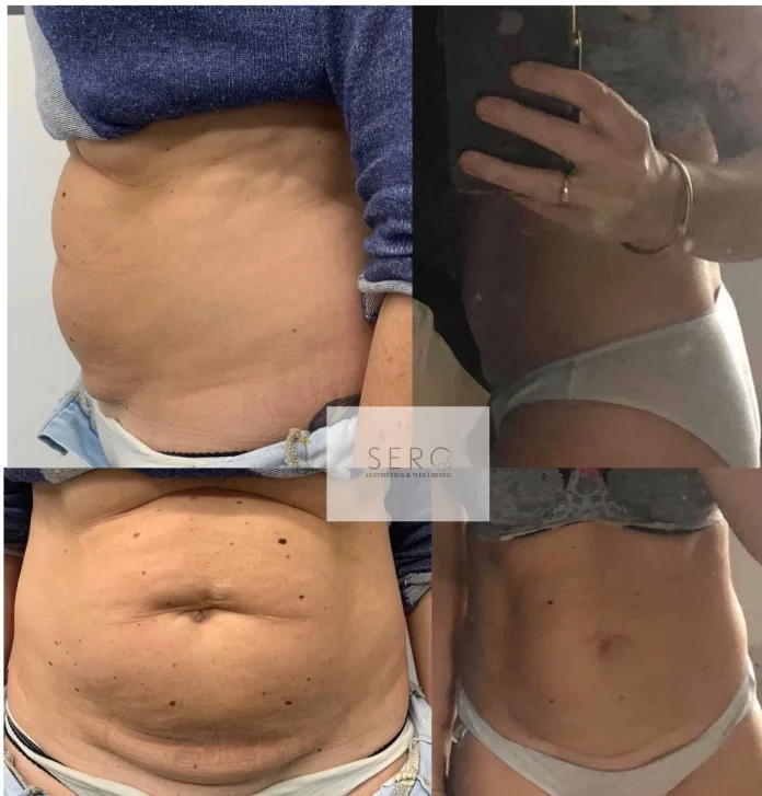 About Aqualyx Fat-Dissolving Injections